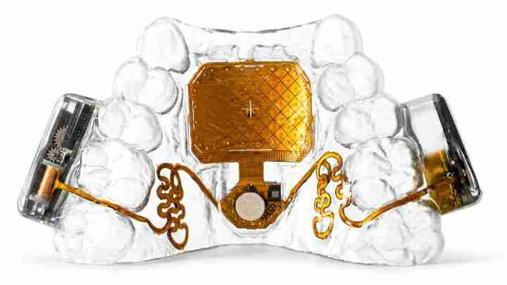 Transparent dental jaw model displaying a gold-colored implant prosthesis with circuit-like wiring and side components for demonstration purposes.